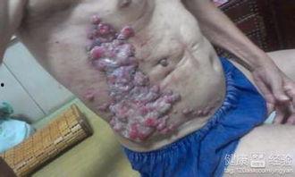 网红淋巴癌,关注健康，远离疾病阴影